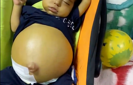 Thumbnail preview image for the video titled: Baby in Gaza contracts liver disease from widespread hepatitis A linked to sewage exposure