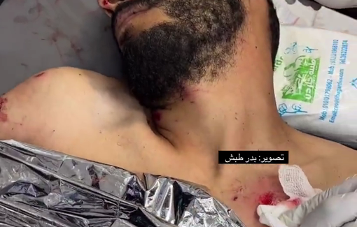 Thumbnail preview image for the video titled: Journalist Hassan Eslayeh receiving treatment following an Israeli airstrike on his tent