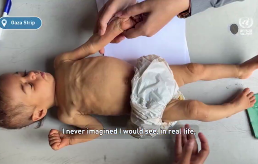 Thumbnail preview image for the video titled: Malnutrition among children in Gaza is increasing.'I never imagined I would see in real life cases of this scale and severity,'