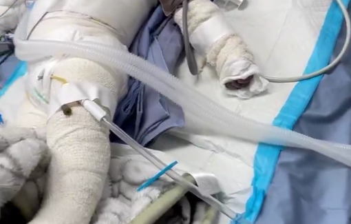 Thumbnail preview image for the video titled: Wounded baby with serious burn injuries, sole survivor of his family